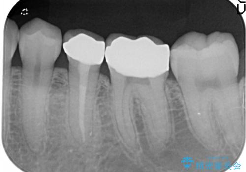 【メタルフリー】銀歯を白くしたい。オールセラミッククラウン。の治療後
