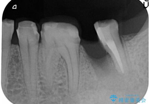 【ヘミセクション】なんとか残したい、割れた奥歯。の治療中