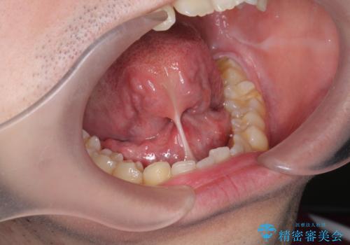 滑舌の改善　舌小帯の形成の治療前