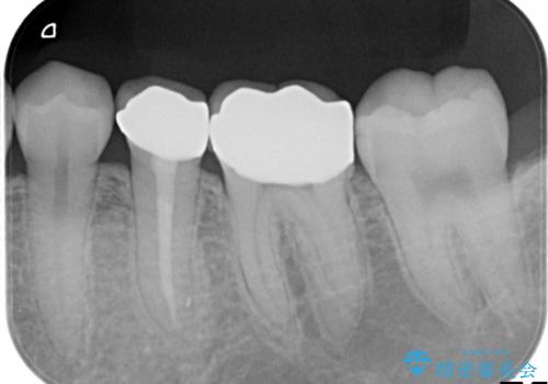 【メタルフリー】銀歯を白くしたい。オールセラミッククラウン。の治療前