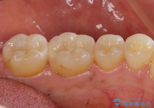 [セラミック治療]  目立つ銀歯を白く②の症例 治療後
