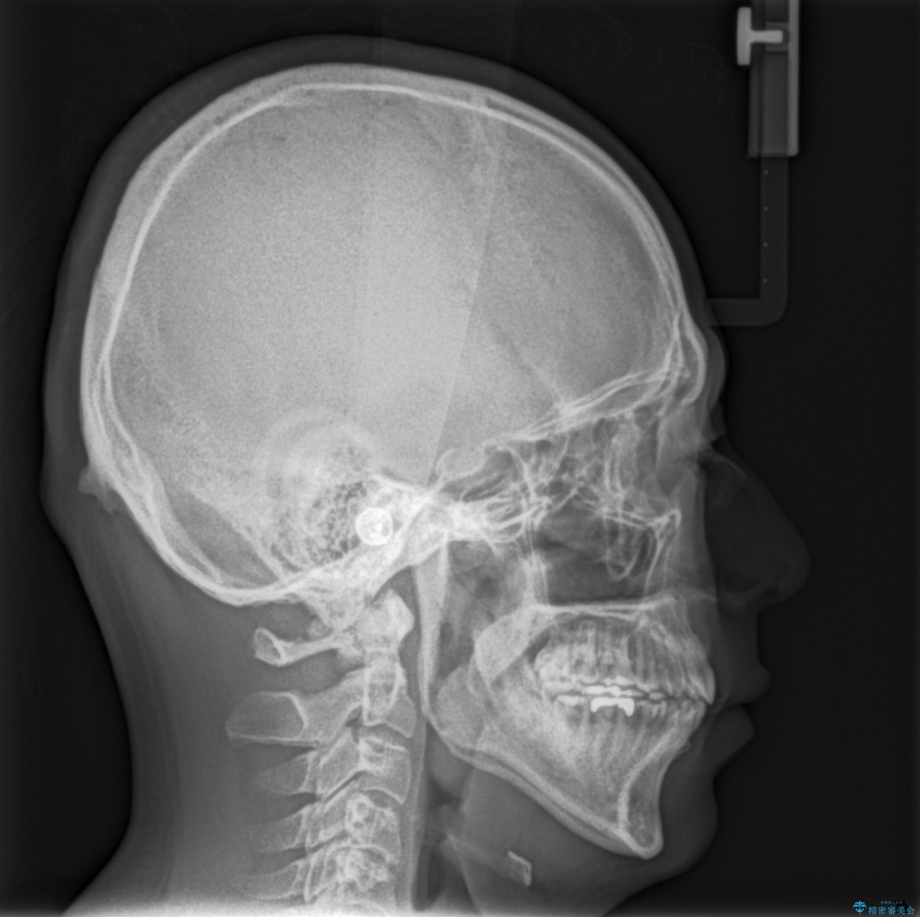 出っ歯の抜歯矯正 裏側ワイヤーによる目立たない矯正の治療後(顔貌)