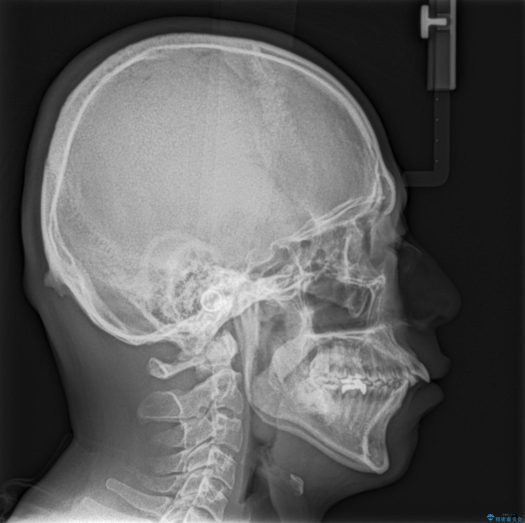 出っ歯の抜歯矯正 裏側ワイヤーによる目立たない矯正の治療前(顔貌)