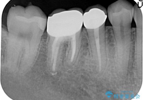 【メタルフリー】銀歯を白くしたい。オールセラミッククラウン。の治療後