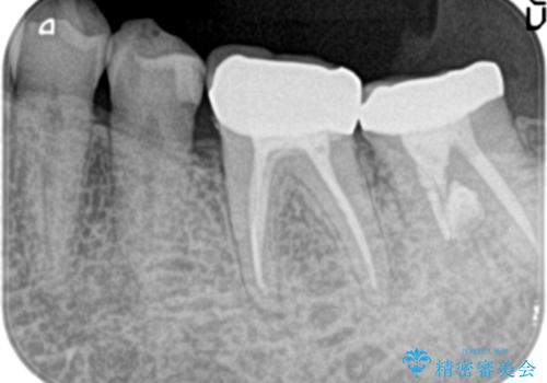 他院で治療しても治らない。奥歯の治療。の治療後