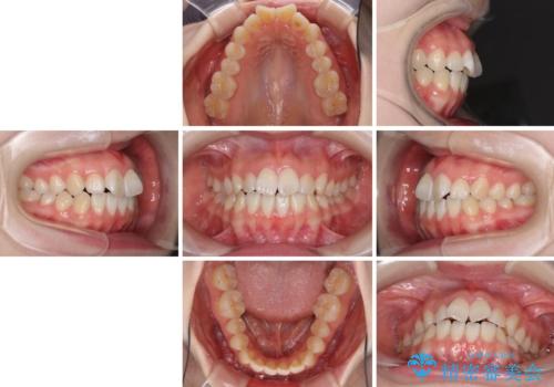 気になる前歯をインビザラインで綺麗にの治療前