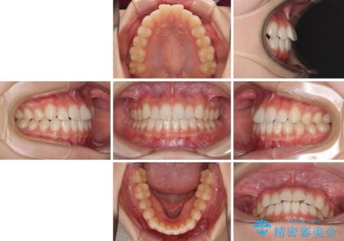 気になる前歯を整えたい インビザライン・ライトでの矯正治療の治療前