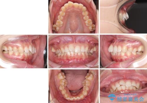 奥歯の倒れた歯を改善 インビザラインでの矯正治療の治療前