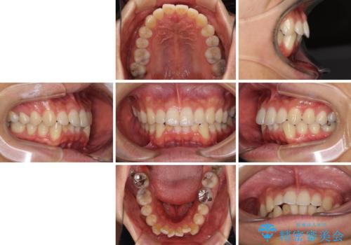 口が少し閉じにくい インビザラインによる非抜歯矯正の治療前