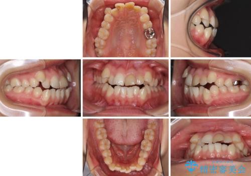 八重歯の抜歯矯正 費用を抑えた矯正装置の治療前