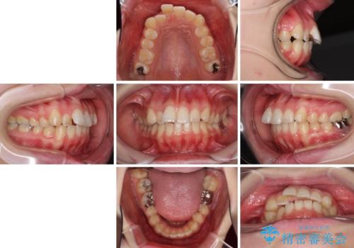 インプラント治療とインビザライン矯正治療 総合歯科治療の治療前
