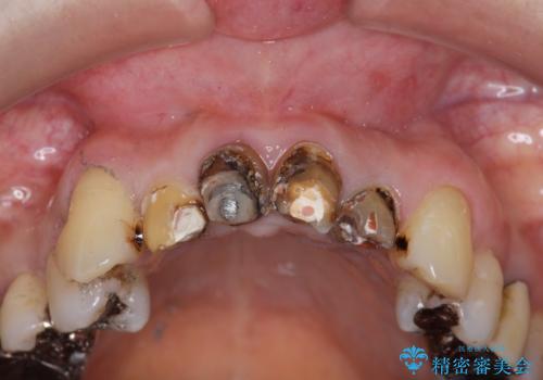 前歯の黒ずみ セラミッククラウン改善の治療中