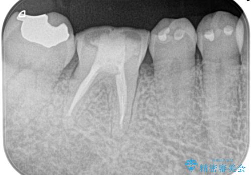 奥歯が痛い。精密根管治療〜オールセラミッククラウンの症例 治療後