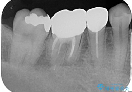 【メタルフリー】銀歯を白くしたい。オールセラミッククラウン。の治療前