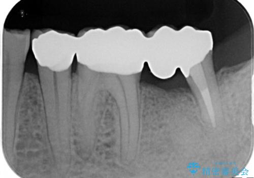 【ヘミセクション】なんとか残したい、割れた奥歯。の治療後