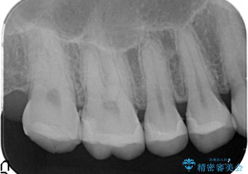 【メタルフリー】銀歯を白くしたい。オールセラミッククラウン。の治療後