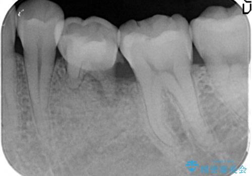 奥歯が痛い。乳歯を抜歯し、ブリッジによる咬合回復。の治療前