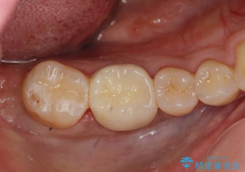 [セラミック治療]  目立つ銀歯を白く①の治療後