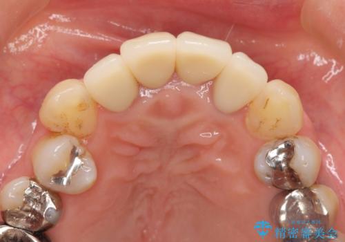 前歯の黒ずみ セラミッククラウン改善の治療後