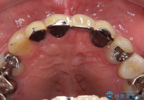 ノンクラスプデンチャー　抜歯になった歯の補綴の治療前
