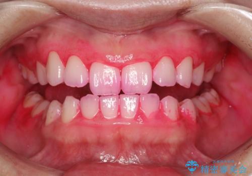 毎月のメンテナンスの治療前