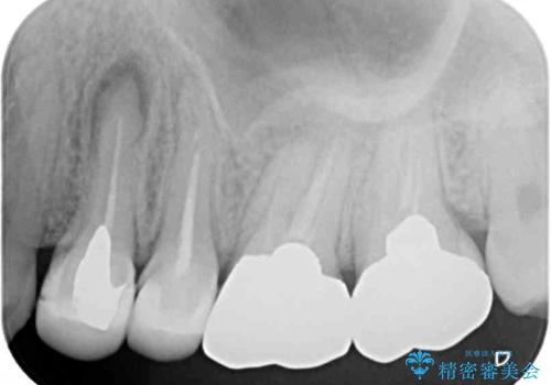 結婚式前に目立つ銀歯をセラミックにの治療前