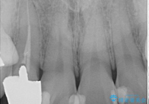 オールセラミッククラウン 被せ物の継ぎ目が気になるの治療前