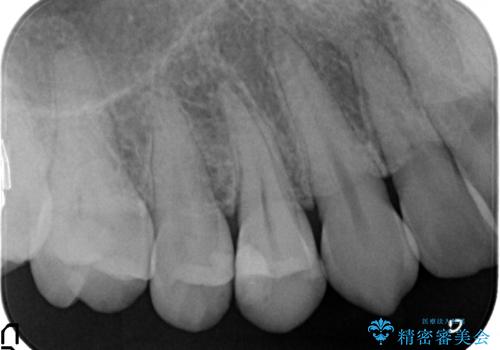 オールセラミッククラウン　歯茎の腫れが引かない歯の治療の治療前