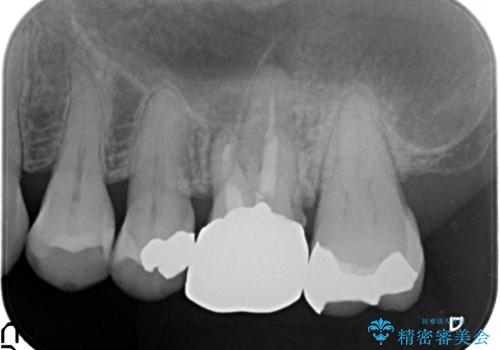 オールセラミッククラウン 口臭の原因であるフィステル(膿の出口)の治療の治療前