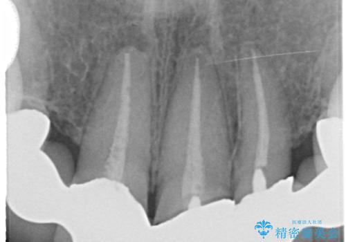 オールセラミッククラウン 前歯の被せ物を綺麗にの治療前