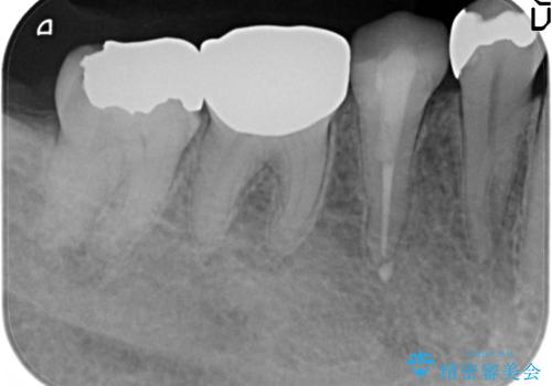 PGA(ゴールド)インレー 甘いものがしみる歯の治療の治療前