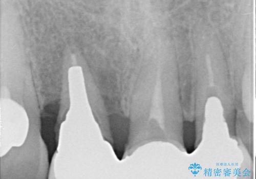 前歯のブリッジ オールセラミッククラウン 歯根が割れてしまった歯の治療の治療前