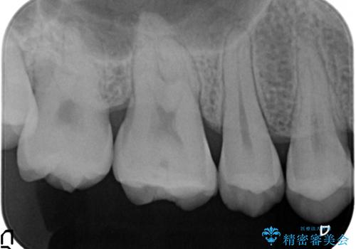 PGA(ゴールド)インレー 欠けた古い樹脂のやり替えの治療前