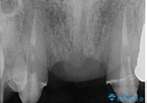 話しにくく腫れやすい前歯のブリッジ 使用感の良いオールセラミックブリッジにの治療前