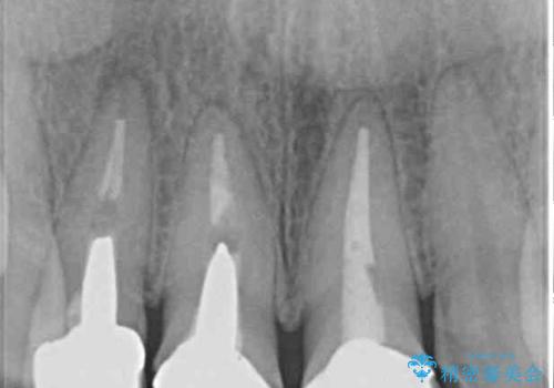 前歯の審美歯科治療 オールセラミッククラウンと部分矯正の治療前