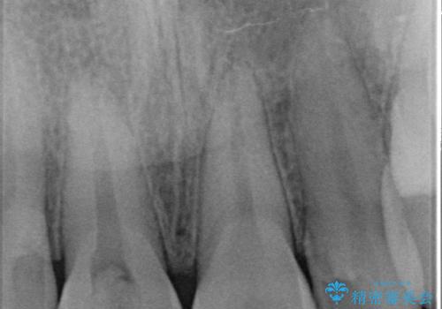 オールセラミッククラウン 痛みの引かない歯の治療