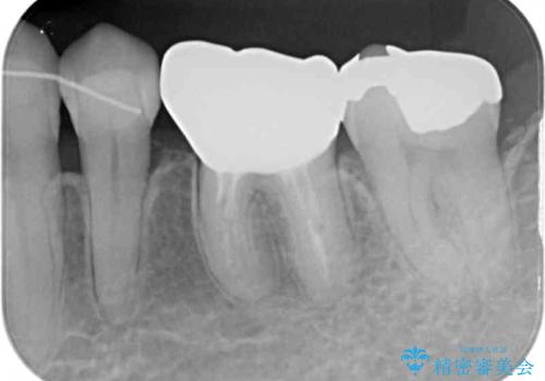 話しにくく腫れやすい前歯のブリッジ　使用感の良いオールセラミックブリッジにの治療後
