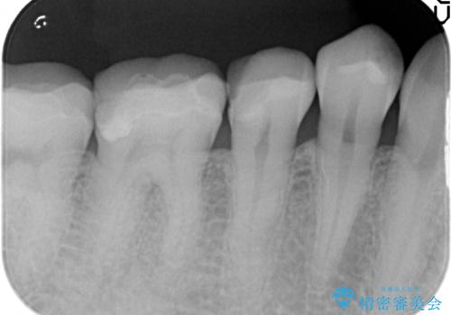 オールセラミッククラウン 神経が死んでいる歯の治療の治療前