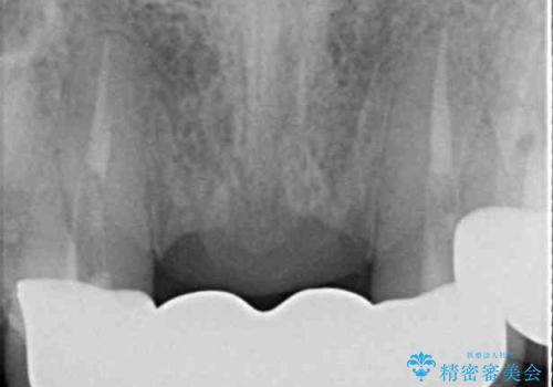 話しにくく腫れやすい前歯のブリッジ 使用感の良いオールセラミックブリッジにの治療後