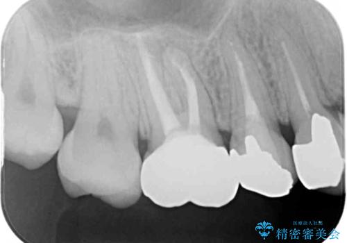 結婚式前に目立つ銀歯をセラミックにの治療後