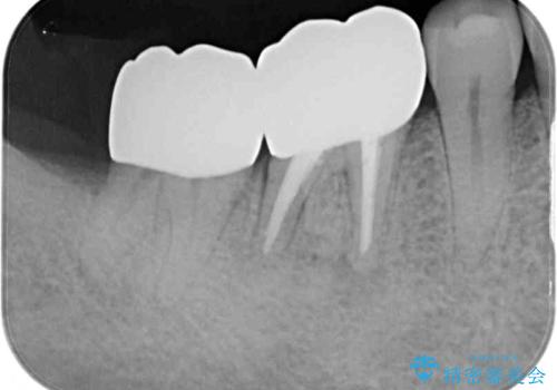 骨の中にまで及んだ深い虫歯　歯周外科処置を用いた補綴治療の治療後