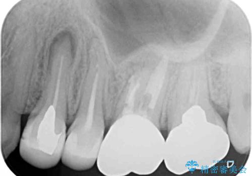 結婚式前に目立つ銀歯をセラミックにの治療後