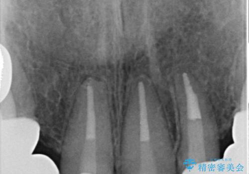 オールセラミッククラウン 前歯の被せ物を綺麗にの治療後