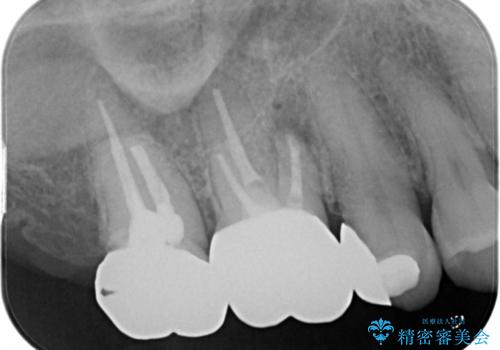 歯ぐきにニキビのようなものができた:原因から改善、被せ物までの治療後