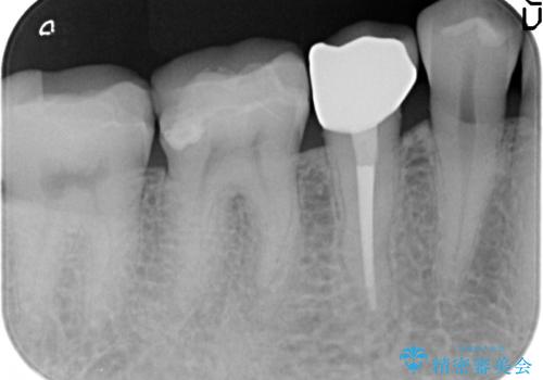 オールセラミッククラウン 神経が死んでいる歯の治療の治療後