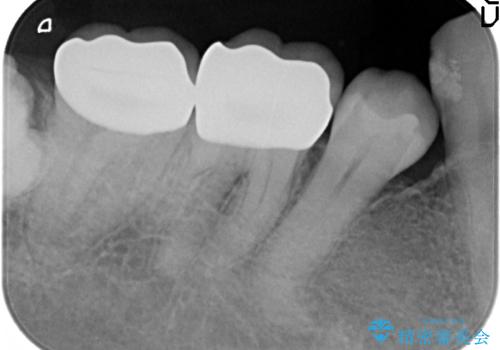 オールセラミッククラウン 奥歯の見た目の改善の治療後