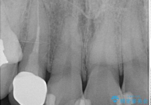 オールセラミッククラウン 被せ物の継ぎ目が気になるの治療後
