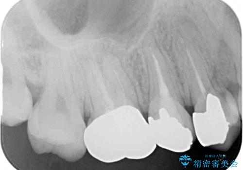 結婚式前に目立つ銀歯をセラミックにの治療前