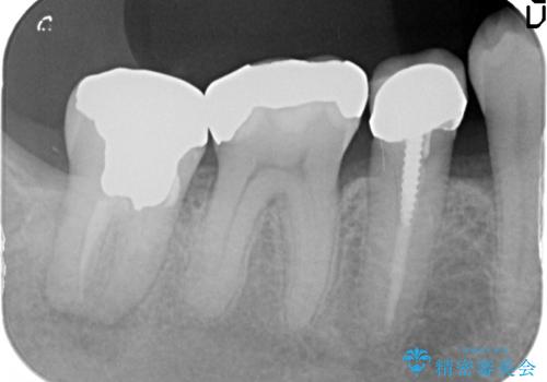 [歯周病再生治療]  根尖に至る骨欠損の改善の治療前
