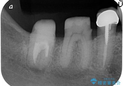 [歯周病再生治療]  根尖に至る骨欠損の改善の治療後